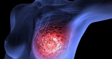 4.4 Million Women Live With Breast Cancer Worldwide ― Expert