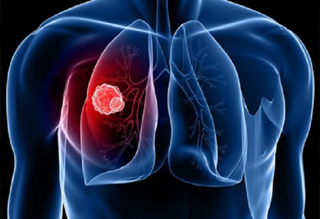 Why Antioxidants May Encourage Spread Of Lung Cancer Rather Than Prevent It