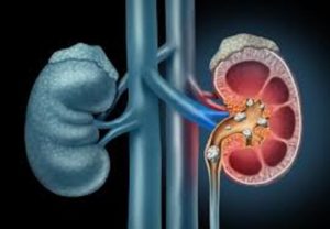 Kidney Disease Now a Global Burden – Dr. Osunbor