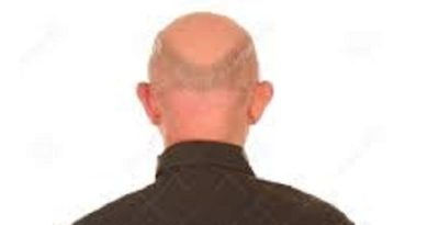 Bald Head Men At Higher Risk Of Coronavirus New Study Reveals